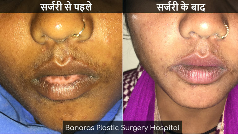 Vitiligo Surgery Vitiligo Management In Varanasi 6589